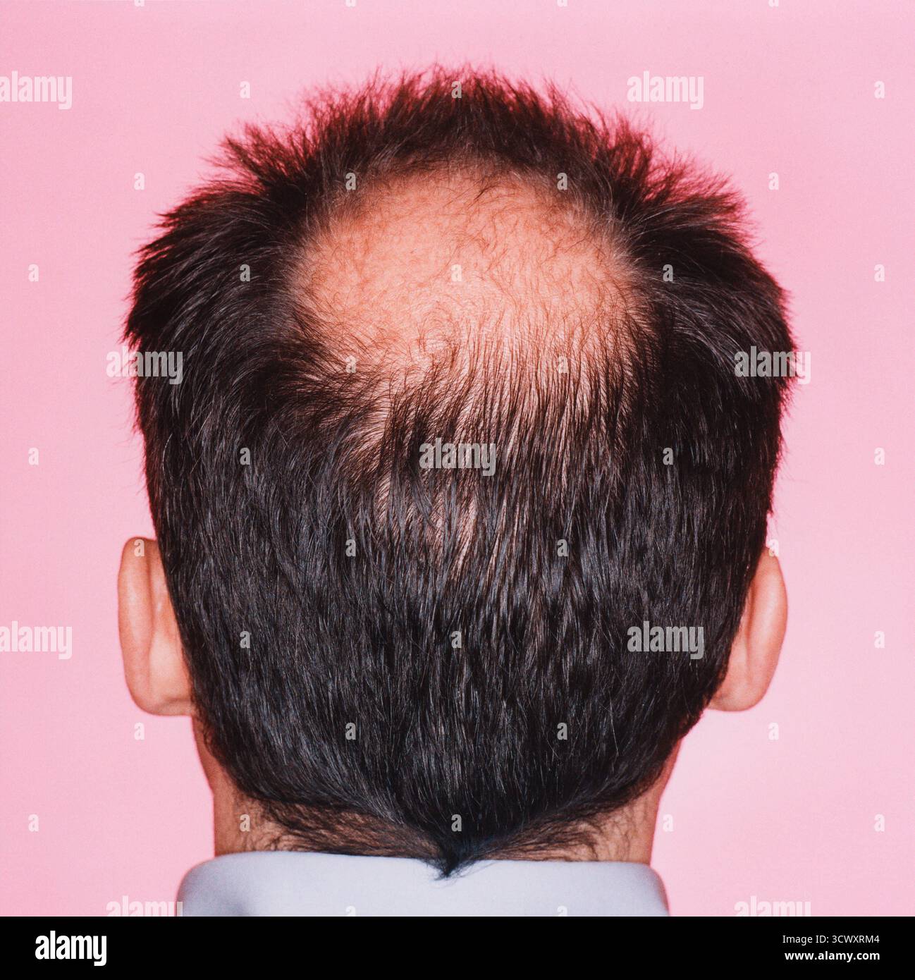 Nahaufnahme eines Hinterkopfs eines Mannes mit einer deutlichen Glatze oder Haarausfall *** Close-up of the back of a mans head with significant baldn Stock Photo