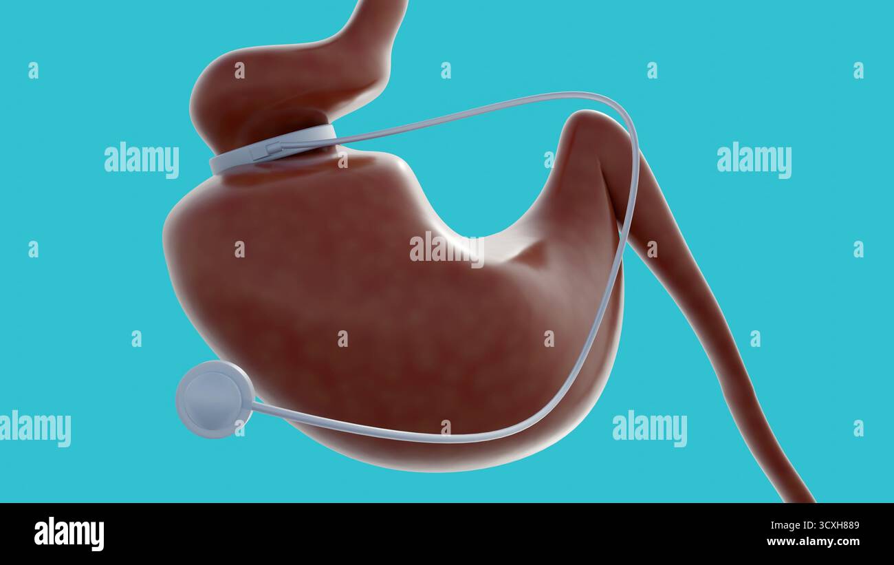 A 3d image of gastric band, is an adjustable, inflatable silicone ...