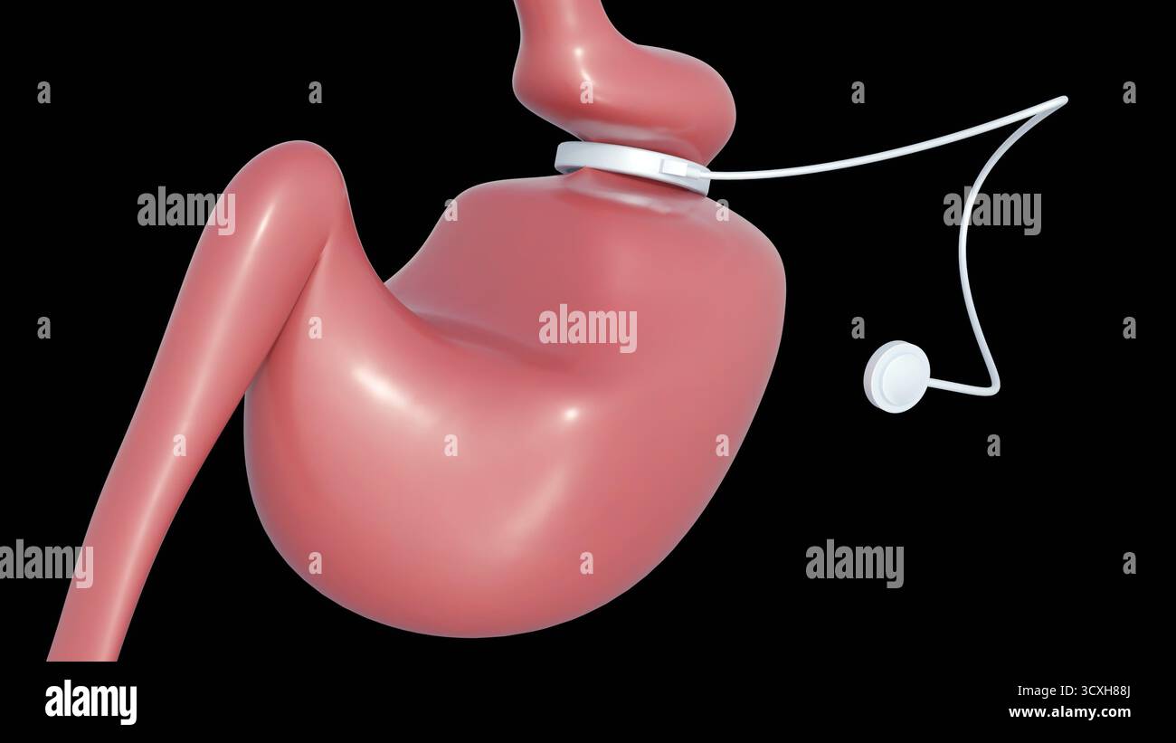 A 3d image of gastric band, is an adjustable, inflatable silicone ...