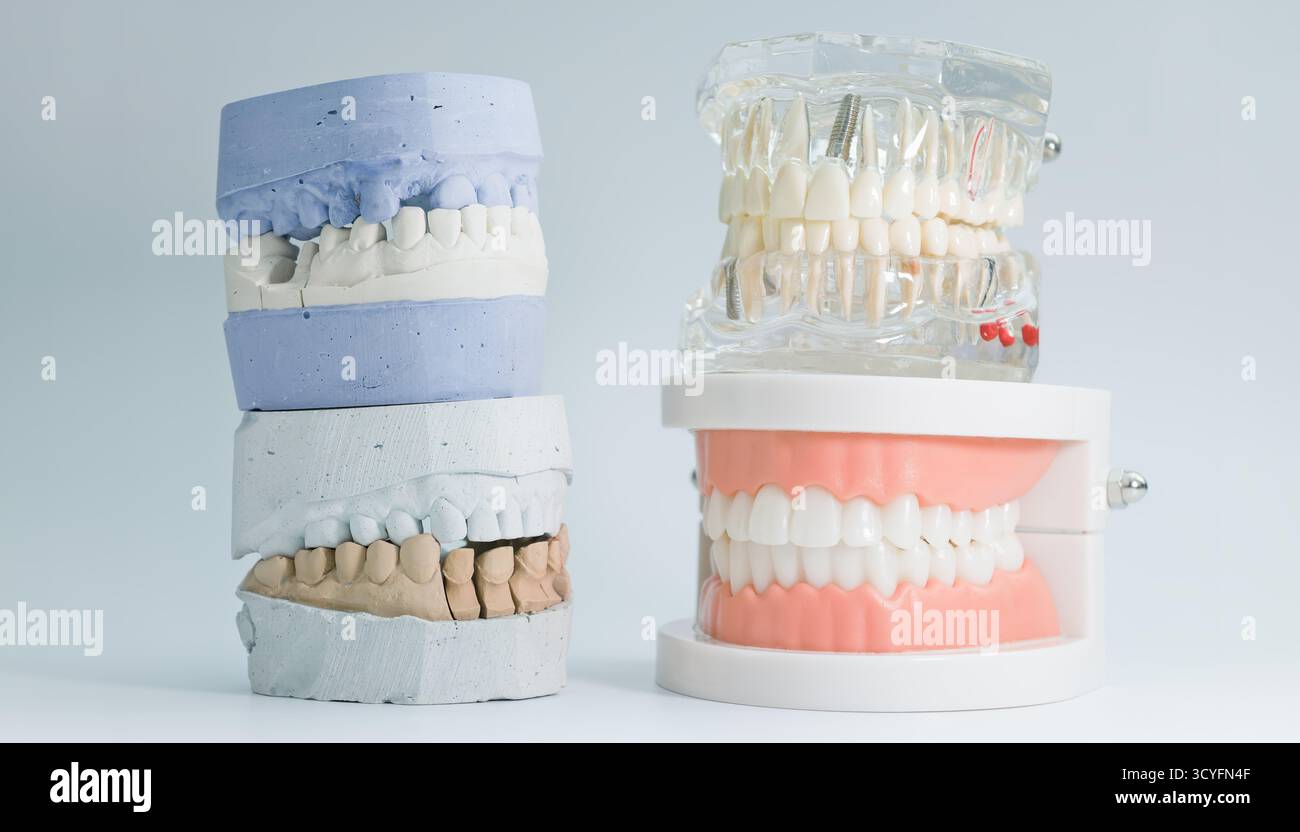 Collection of dental models including plaster casts, implant ...