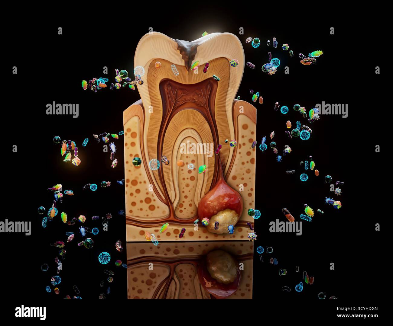 Conceptual 3D illustration of a dental abscess and bacteria under the ...