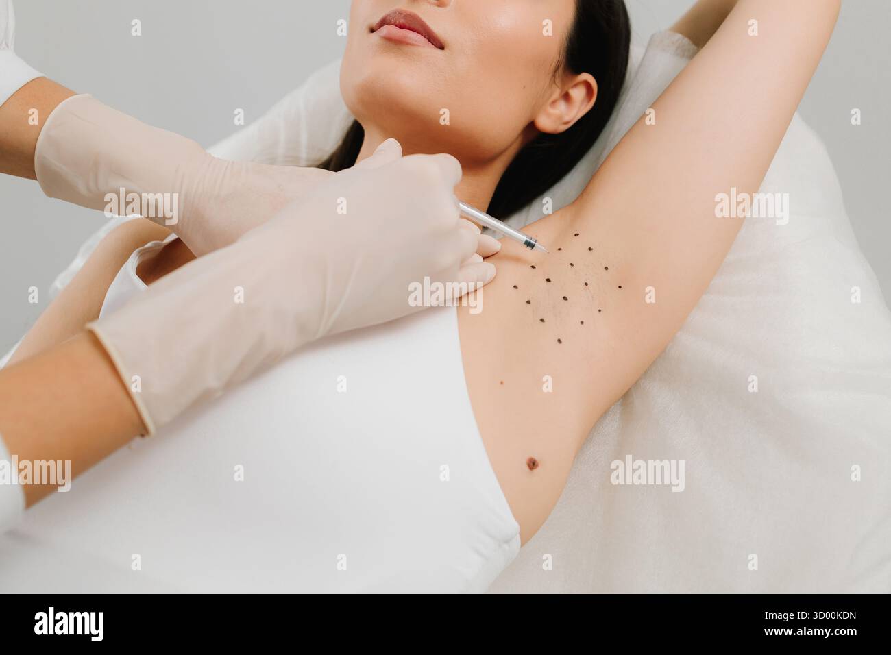 Hyperhidrosis injection for underarm. Intradermal injection procedure ...