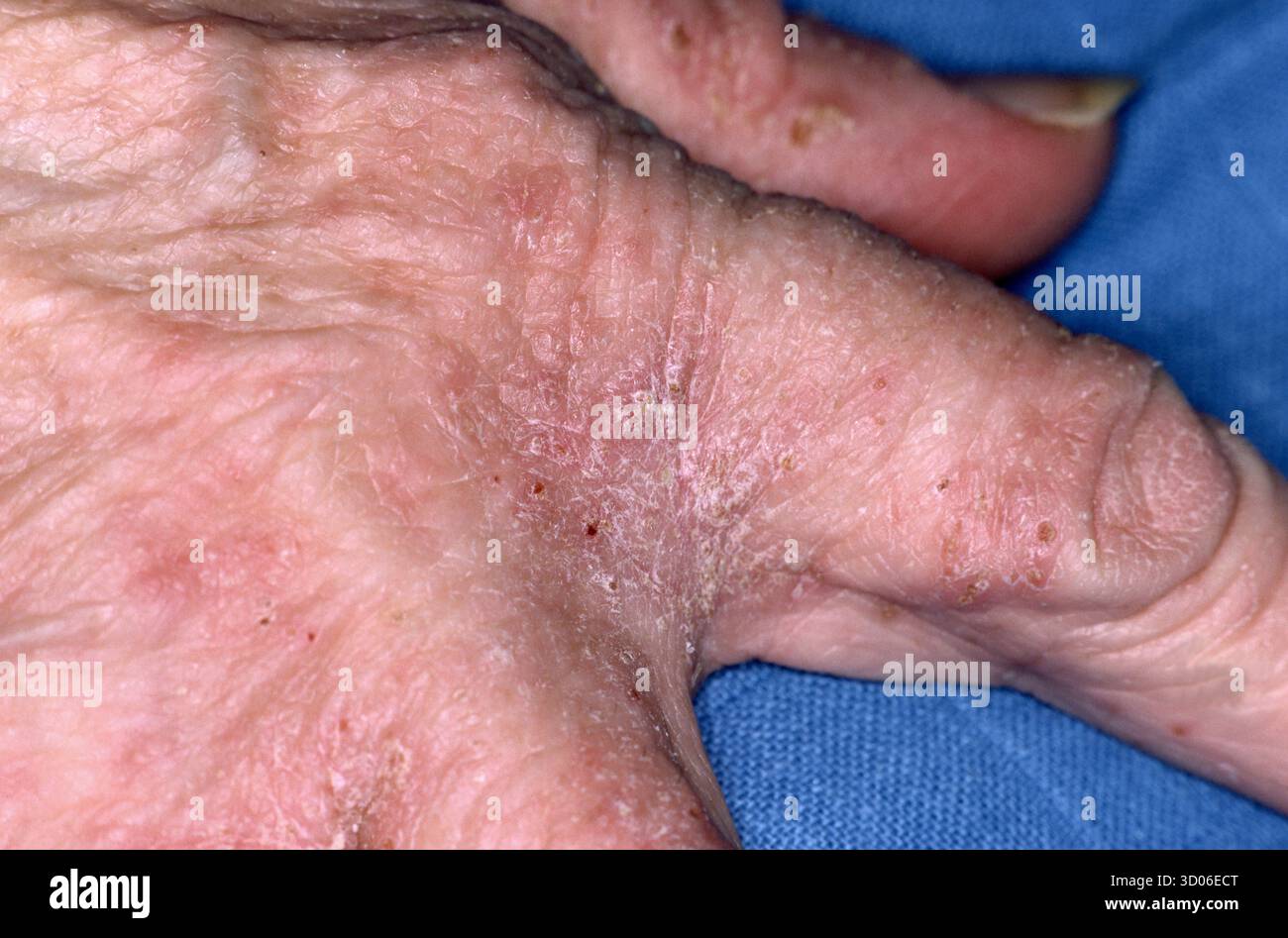 Scabies Rash On The Hand Of A 60 Year Old Male Patient Scabies Is A 