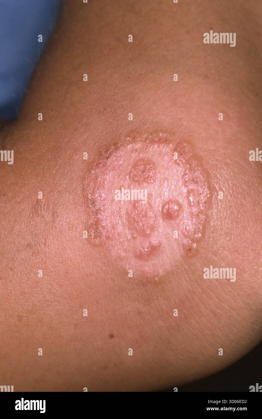 Ringworm infection, also known as Tinea corporis, on the arm of a 26 ...