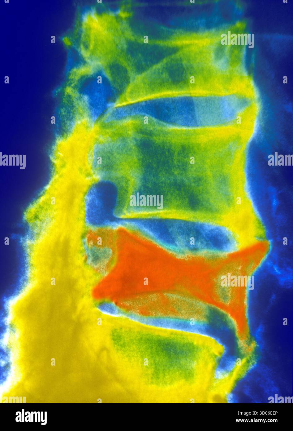 Coloured X-ray of the lumbar (lower) spine showing a compression fracture (red) in a vertebra weakened by osteoporosis. Osteoporosis (brittle bone disease) causes bones to become weaker and more porous, they become more susceptible to injury and fractures, especially when under significant weight or stress. Stock Photo