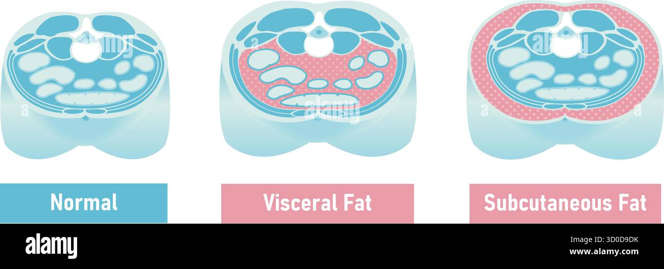 Cross-sectional illustration comparing subcutaneous fat and visceral ...