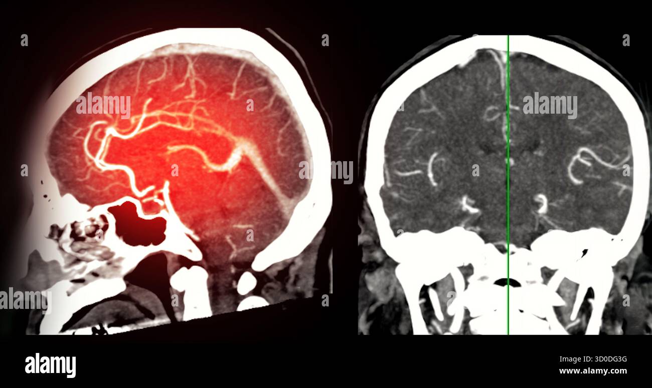 CTA Brain Vascular Imaging , highlights a detailed 3D CTA scan of the ...