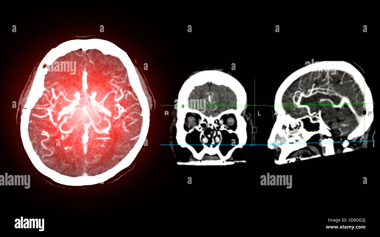 CTA Brain Vascular Imaging , highlights a detailed 3D CTA scan of the ...