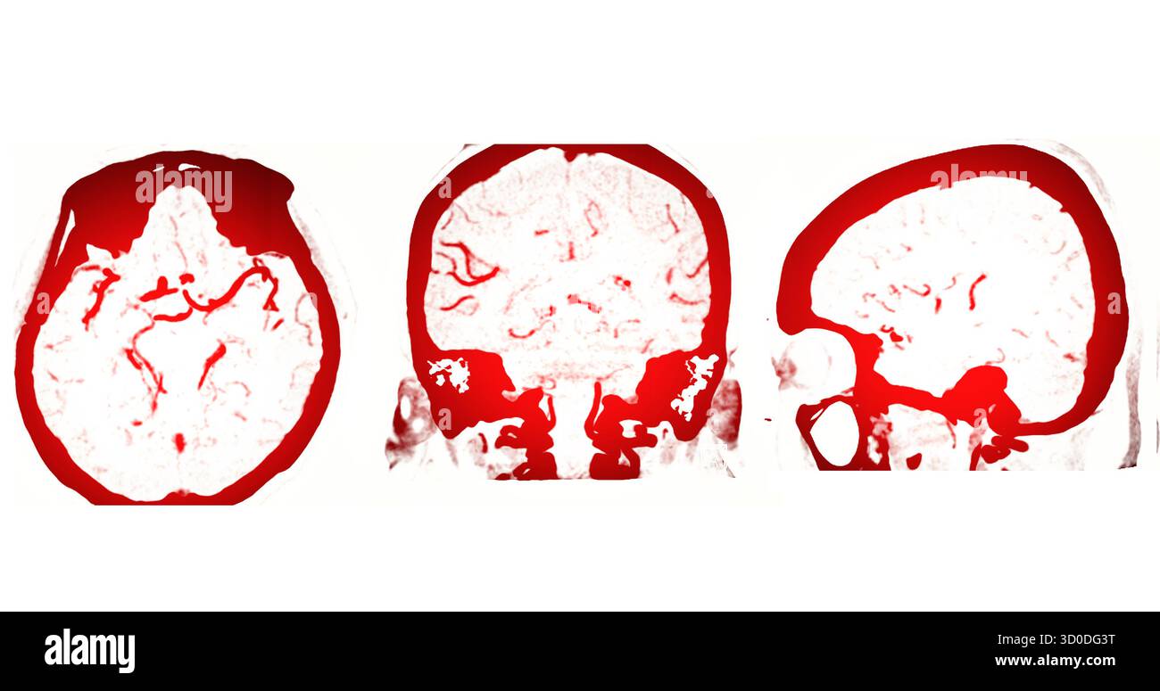 CTA Brain Vascular Imaging , highlights a detailed 3D CTA scan of the ...