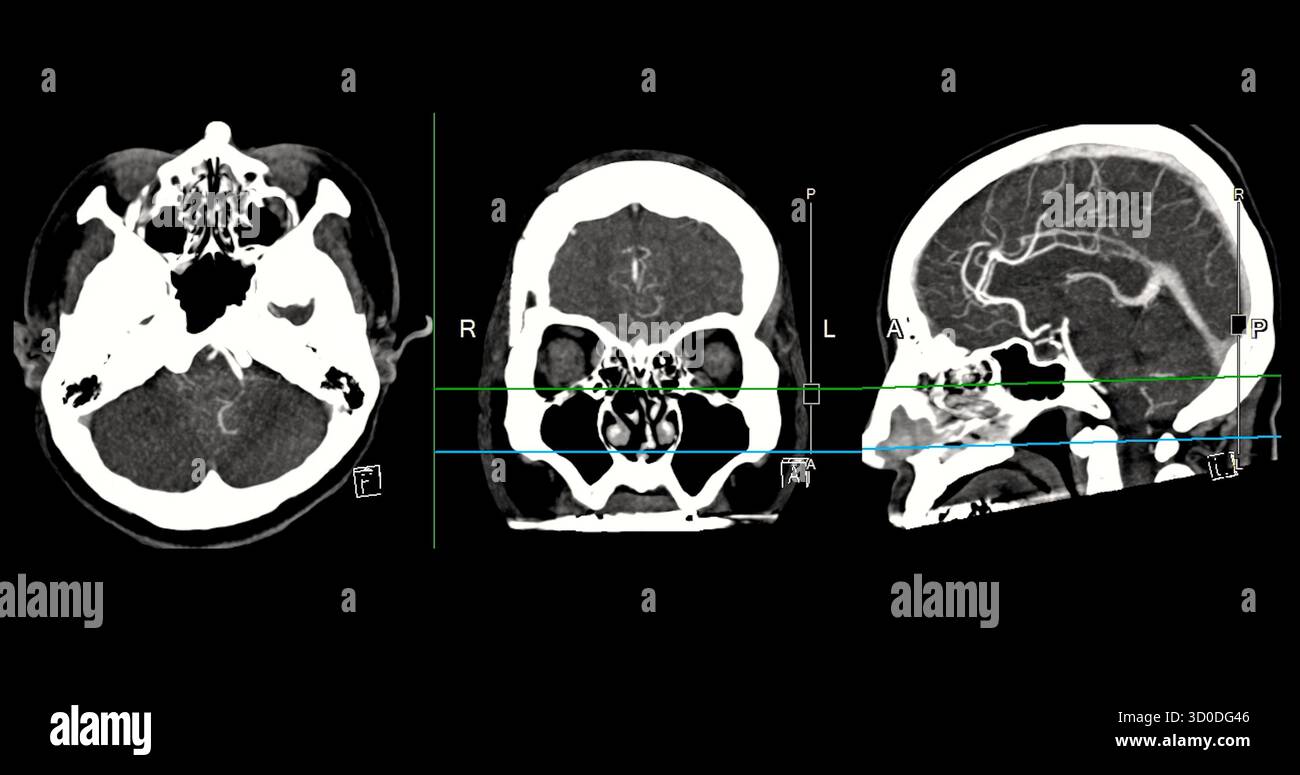 CTA Brain Vascular Imaging , highlights a detailed 3D CTA scan of the ...