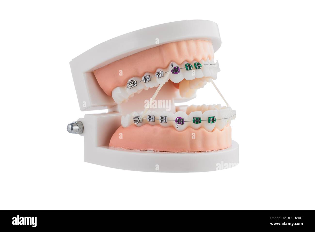Dental Orthodontic Model With Braces Demonstrating Brackets, Wire, and ...