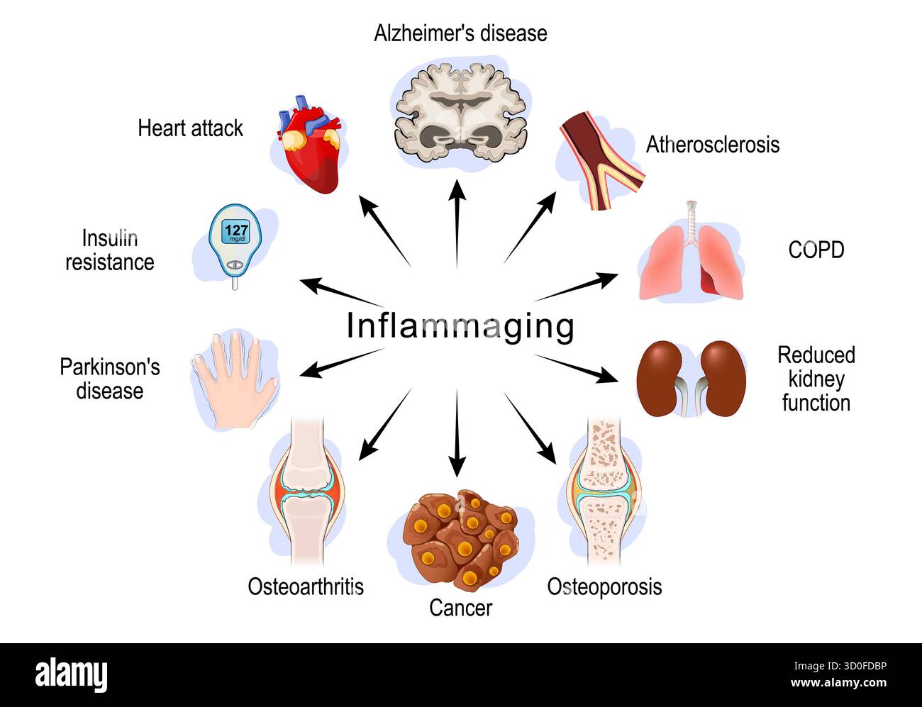Inflammaging Chronic Sterile Low grade Inflammation Aging Process 