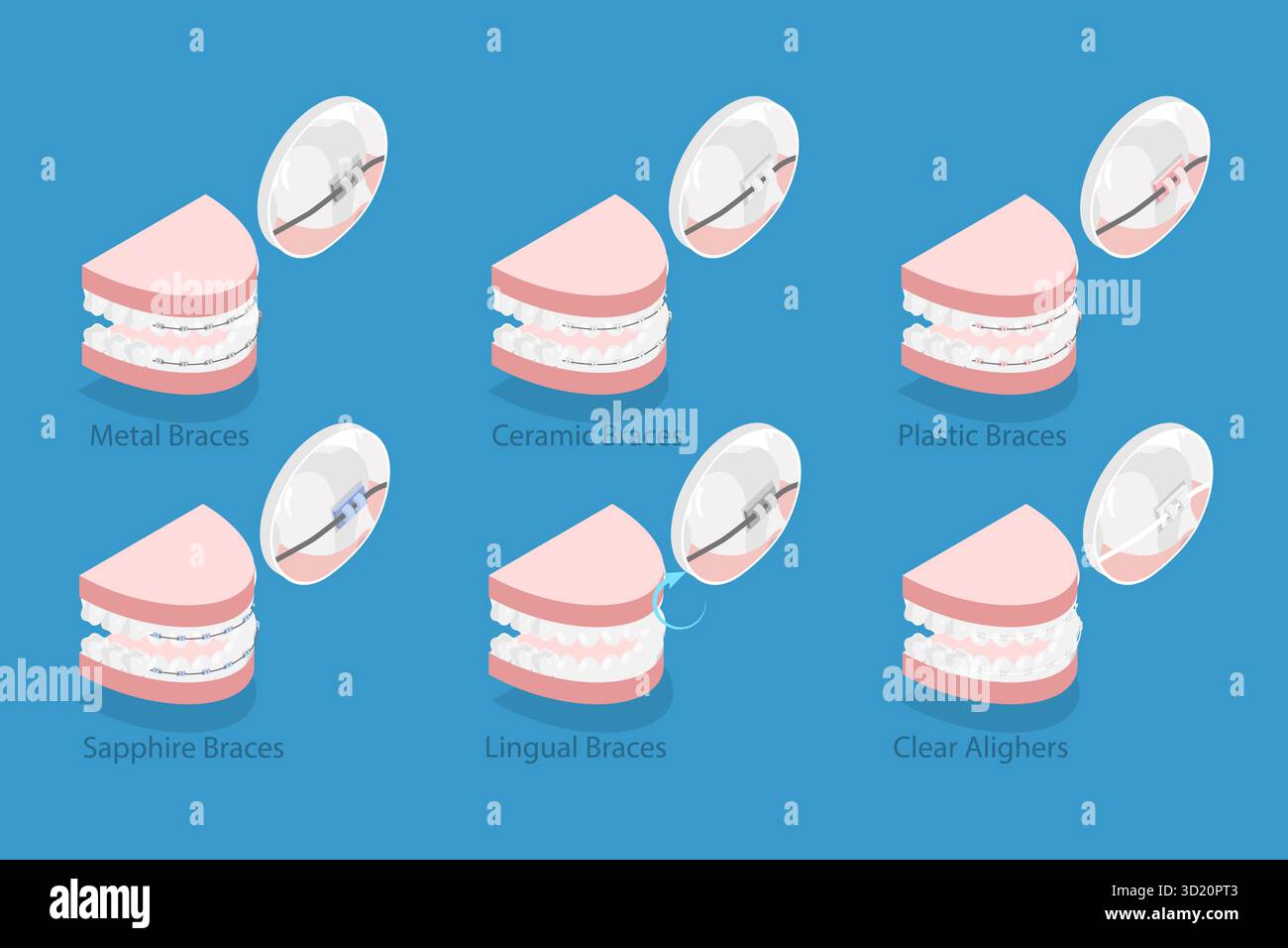 3D Isometric Flat Illustration of Dental Teeth Braces Types ...
