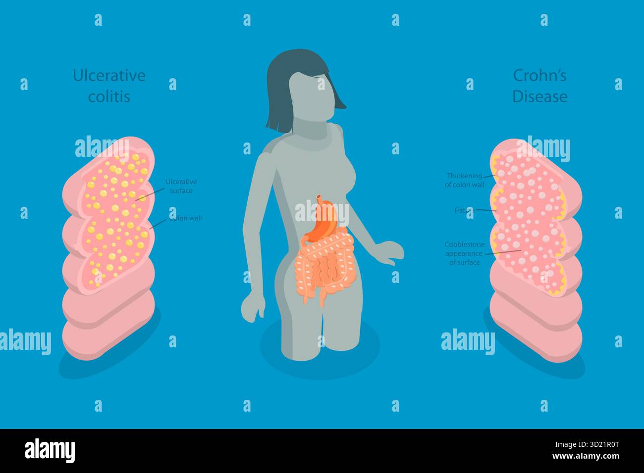 3D Isometric Flat Illustration of IBD, Educational Diagram for ...