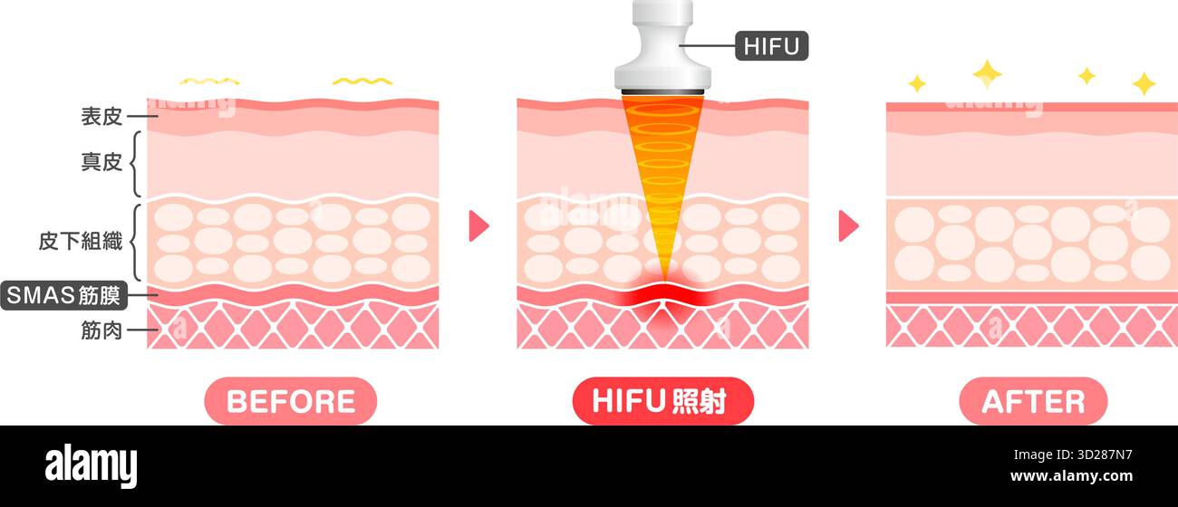 Hyfu Machine Vector Vector illustration of HIFU mechanism and effect Stock Vector Image ...