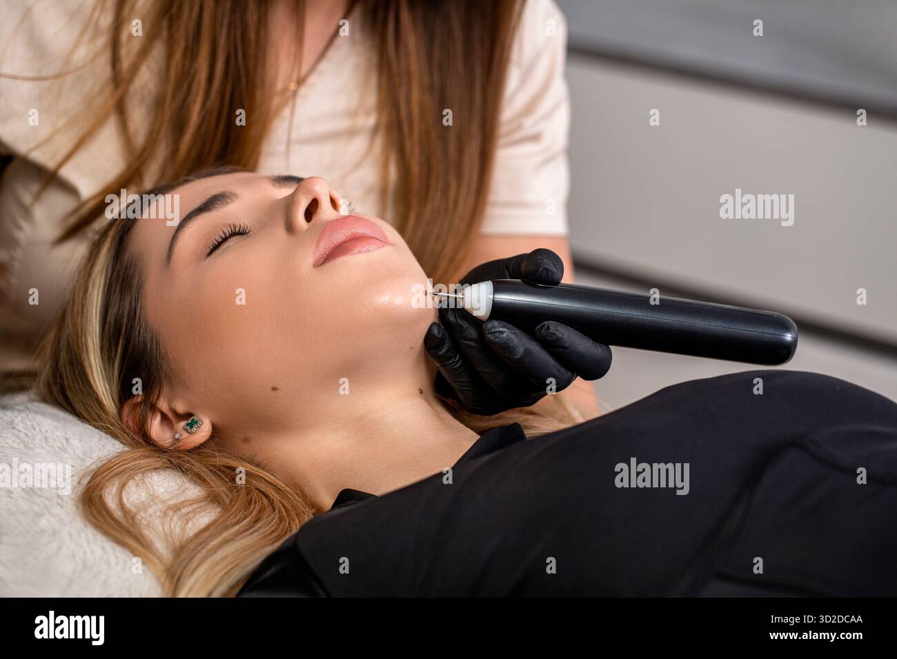 Skin mole removal. Melanoma treatment. Cosmetologist using a laser knife for removing mole. Removal of birthmark from client's chin. Close up. Concept Stock Photo