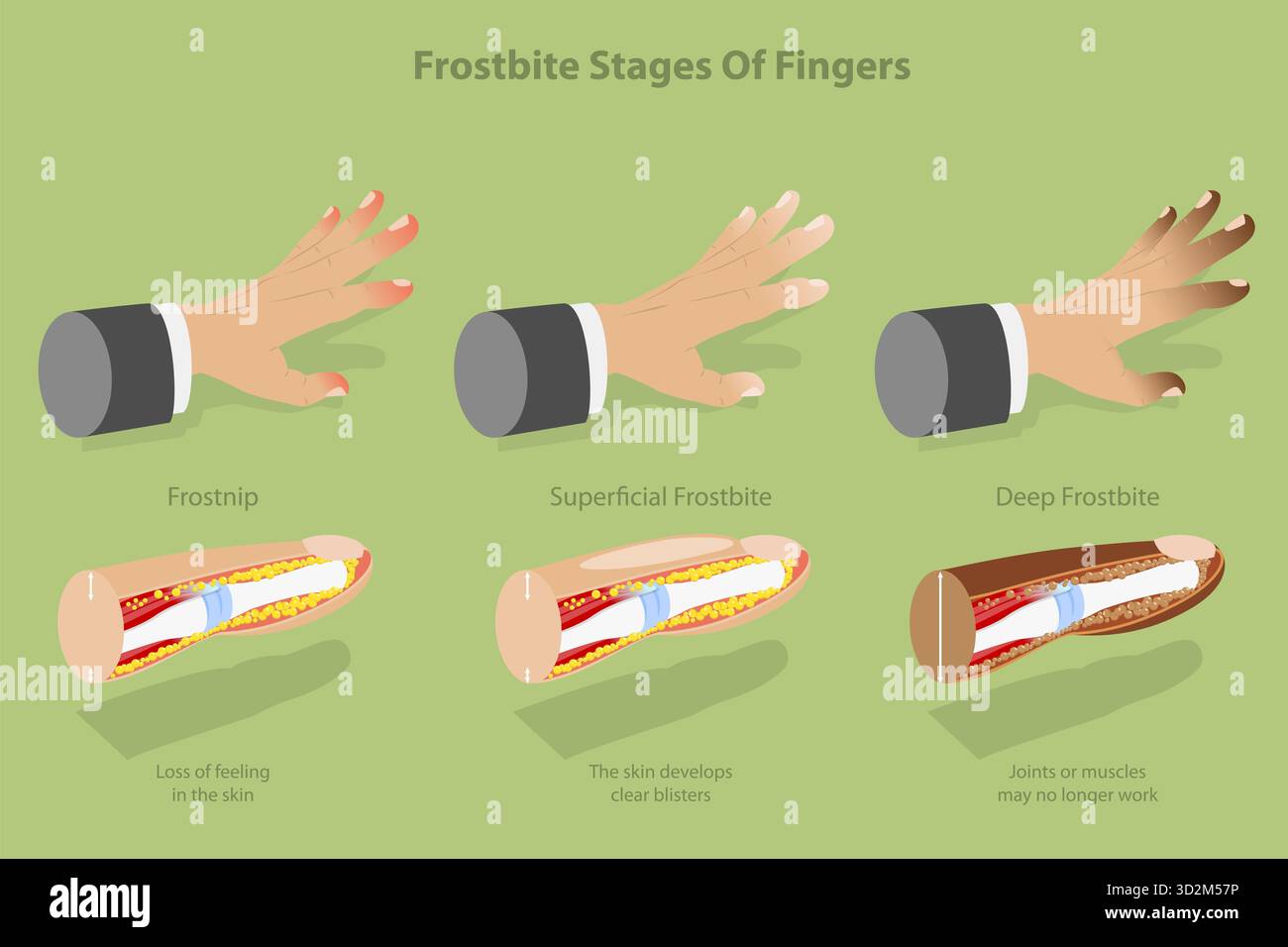 Frosebite Hand 3D Isometric Flat Conceptual Illustration of Frostbite Stages Of ...