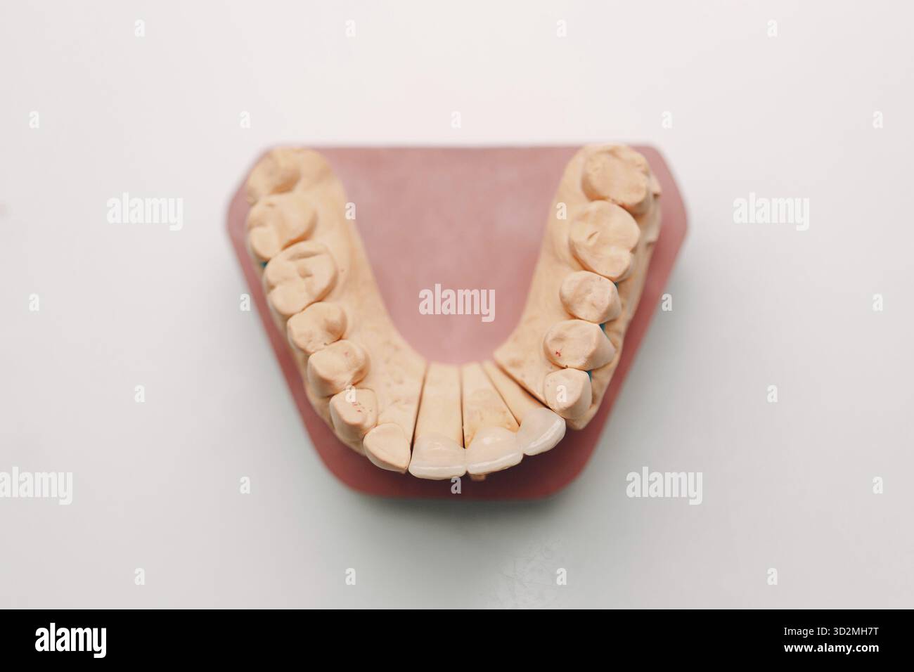 Dental layout of the human jaw with teeth and implants Stock Photo - Alamy