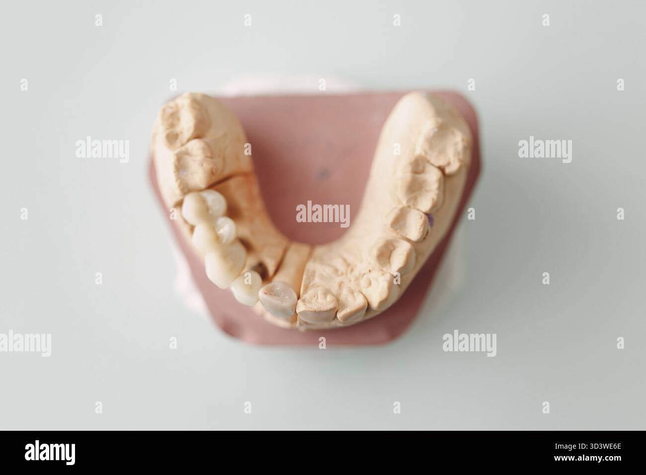 Dental layout of the human jaw with teeth and implants Stock Photo - Alamy