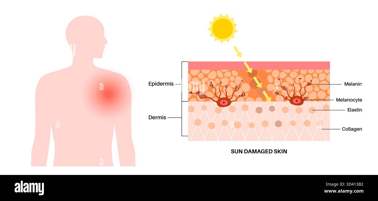 Illustration of skin damage from sunburn. This is caused by the skin ...