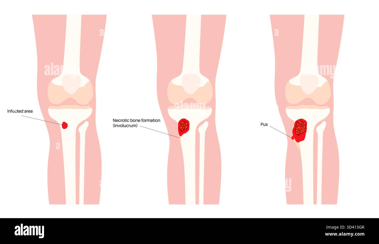 Tibia Abscess Illustration of tibia bone osteomyelitis. This is an infection of the ...