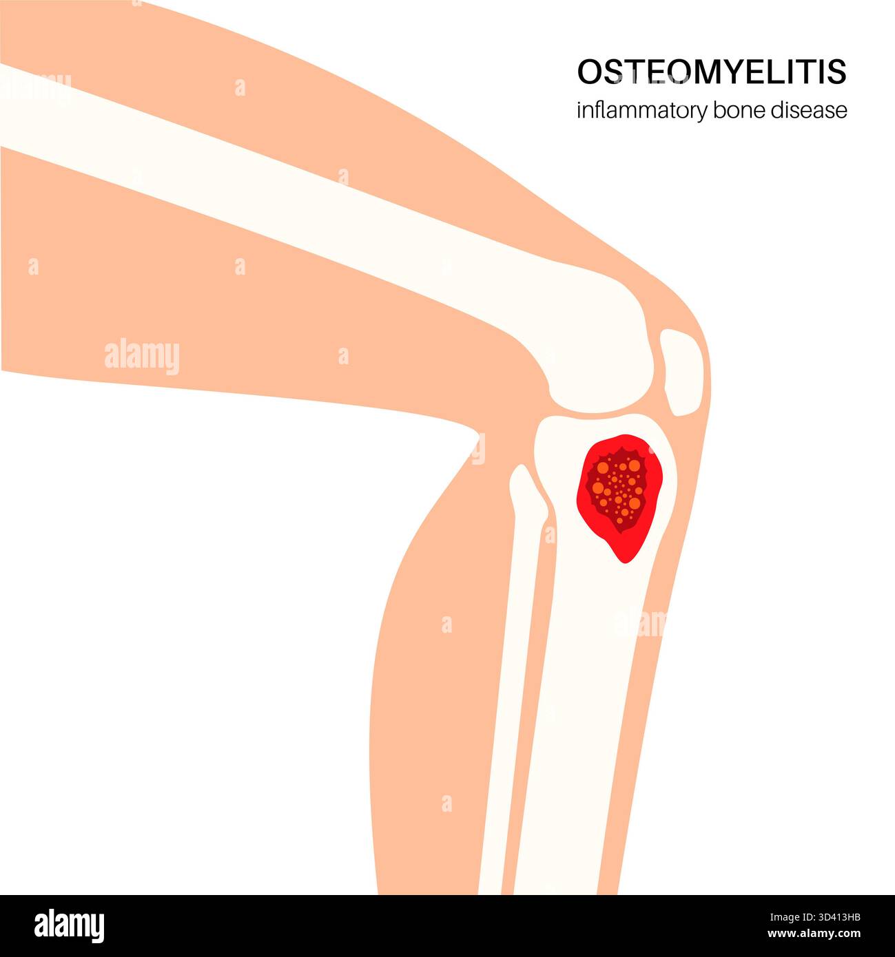 Illustration of tibia bone osteomyelitis. This is an infection of the ...
