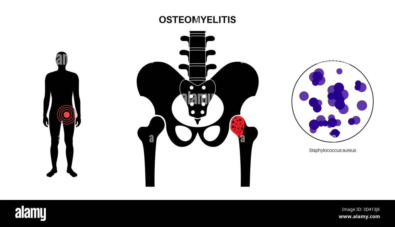 Illustration of hip bone osteomyelitis. This is an infection of the hip ...