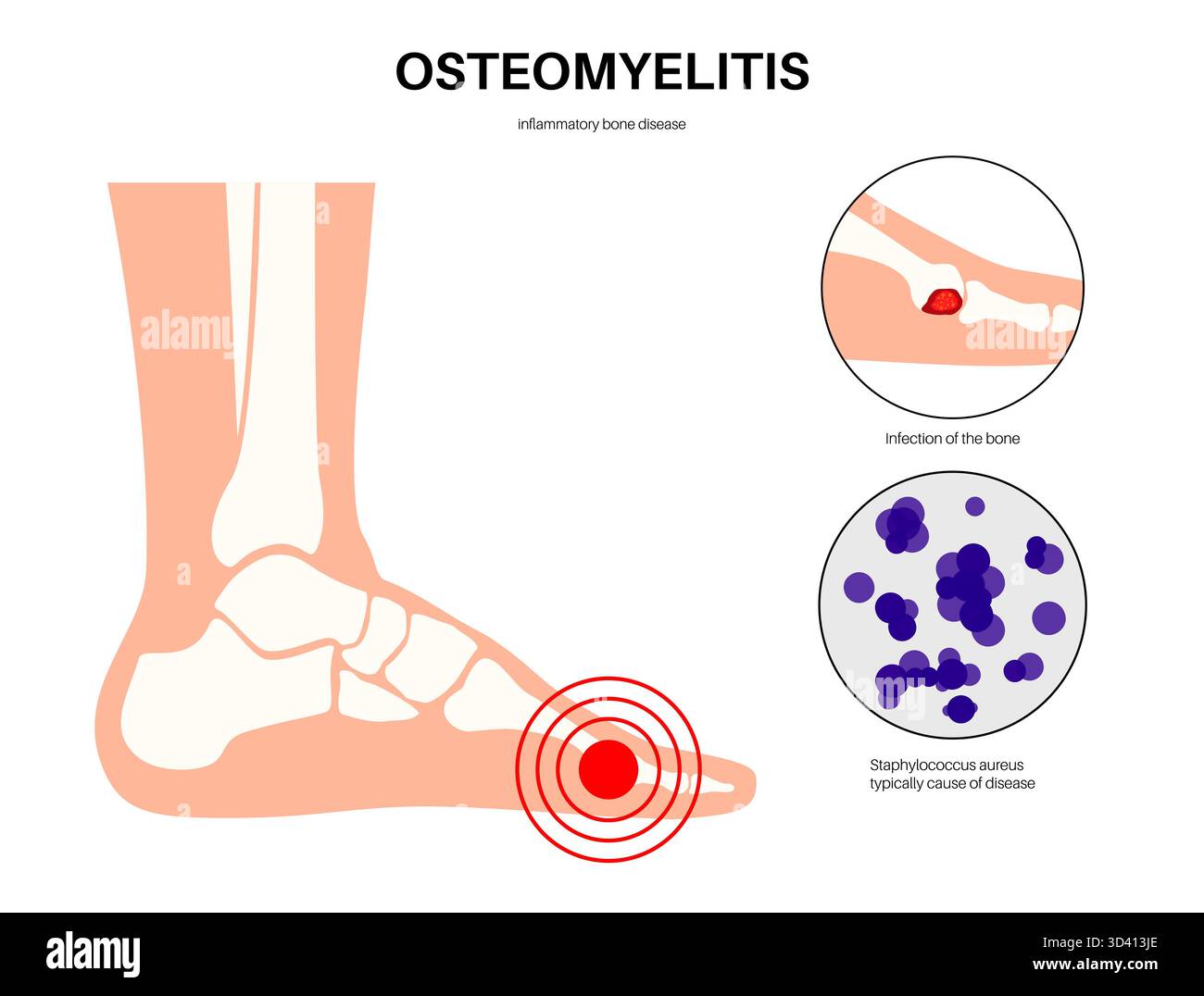 illustration-of-foot-bone-osteomyelitis-this-is-an-infection-of-a-bone