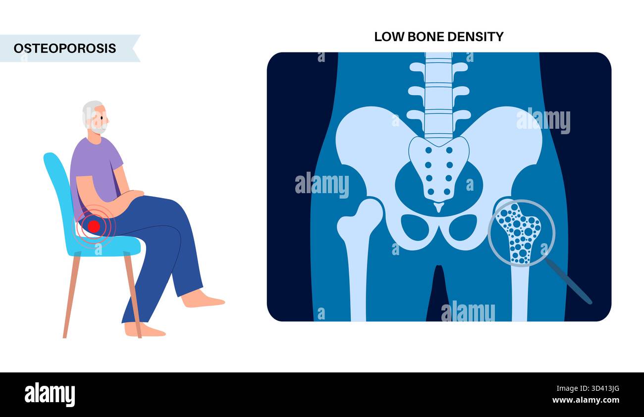 Illustration of osteoporosis. This is a condition that causes bones to ...