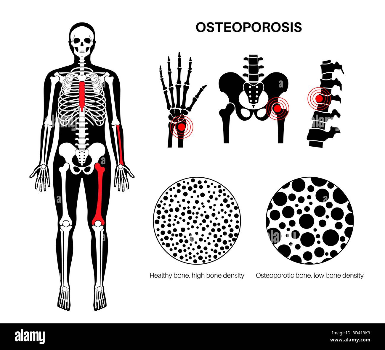 Osteoporosis disease poster. Systemic skeletal disorder of spine, wrist ...