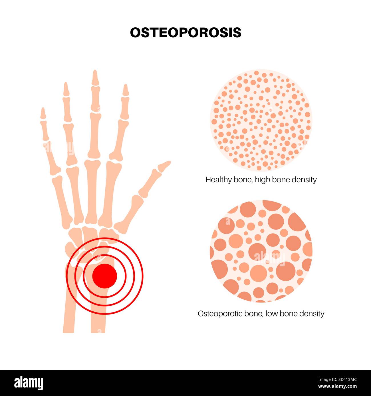 Wrist osteoporosis disease poster. Systemic skeletal disorder, loss of ...