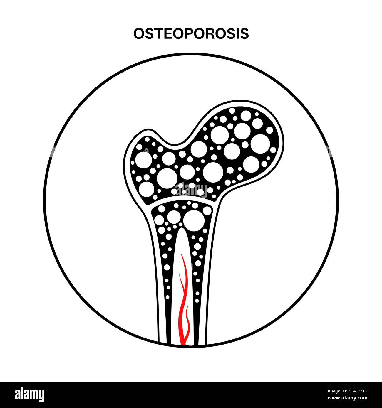 Osteoporosis disease. Systemic skeletal disorder, loss of bone mineral ...