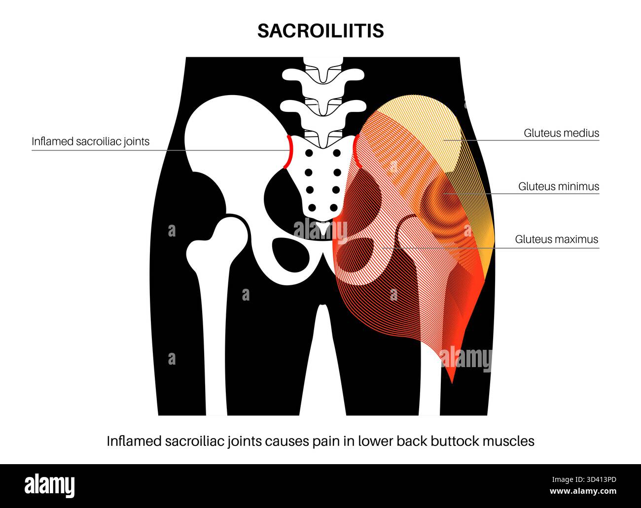 Illustration Of Sacroiliitis This Is An Inflammatory Condition That Illustration Of Sacroiliitis This Is An Inflammatory Condition That