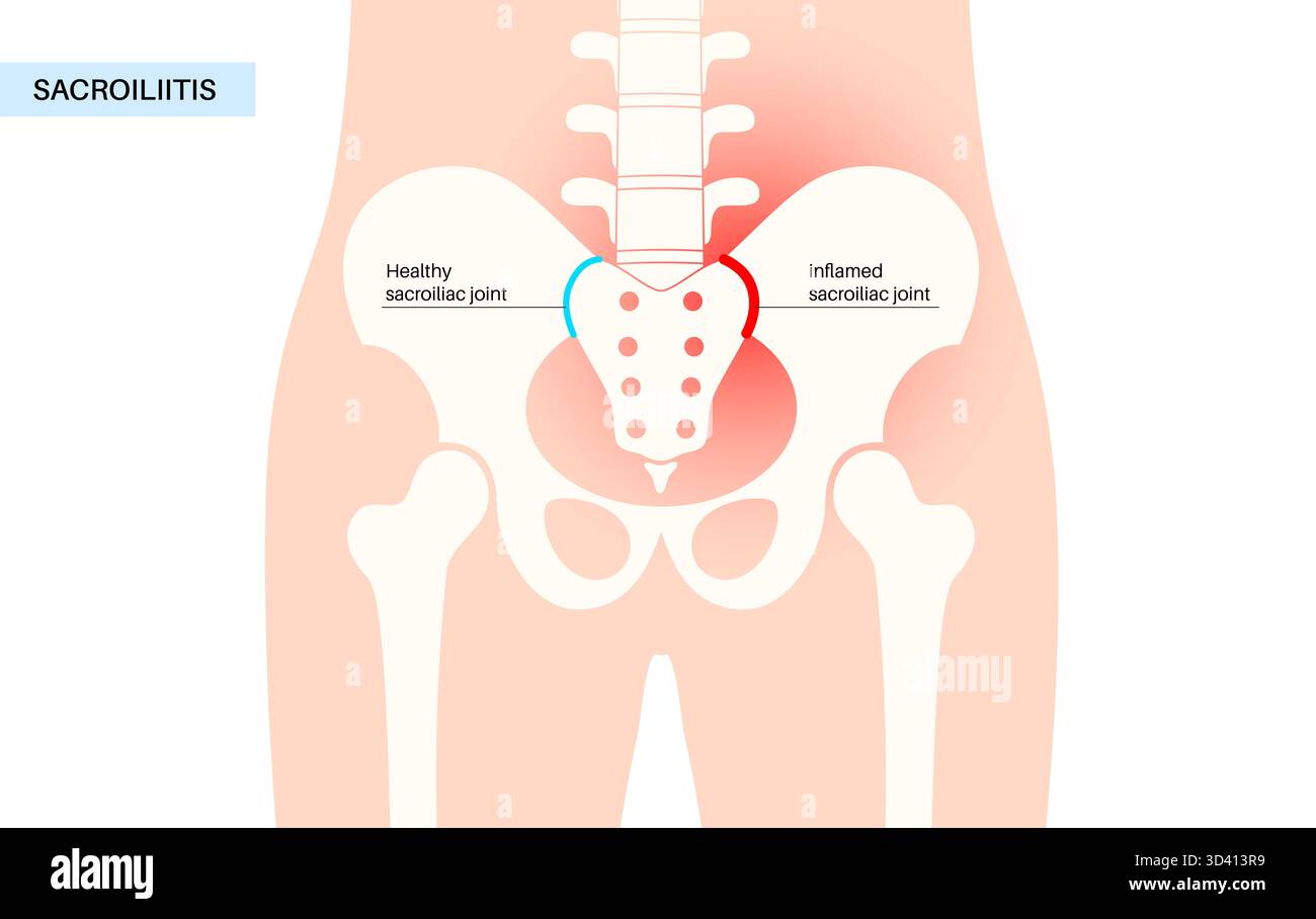 Illustration Of Sacroiliitis This Is An Inflammatory Condition That Illustration Of Sacroiliitis This Is An Inflammatory Condition That