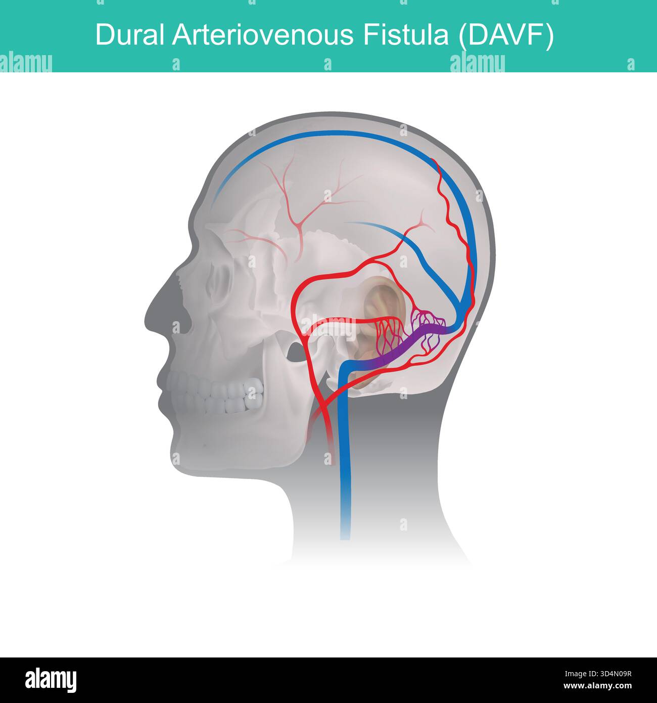 Arteriovenous fistula hi-res stock photography and images - Alamy