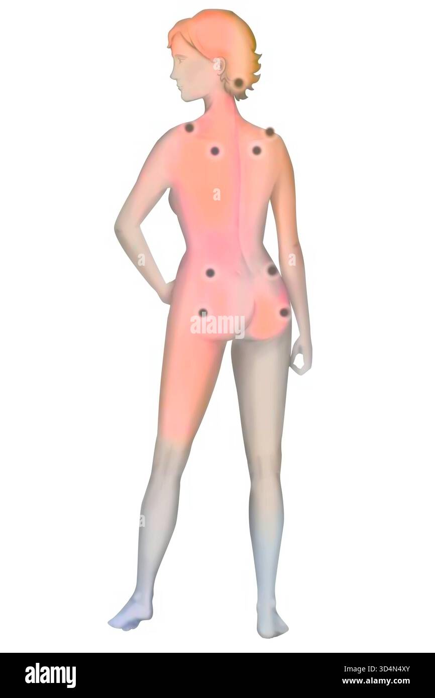 Muscle Rheumatism Fibrositis hi-res stock photography and images - Alamy