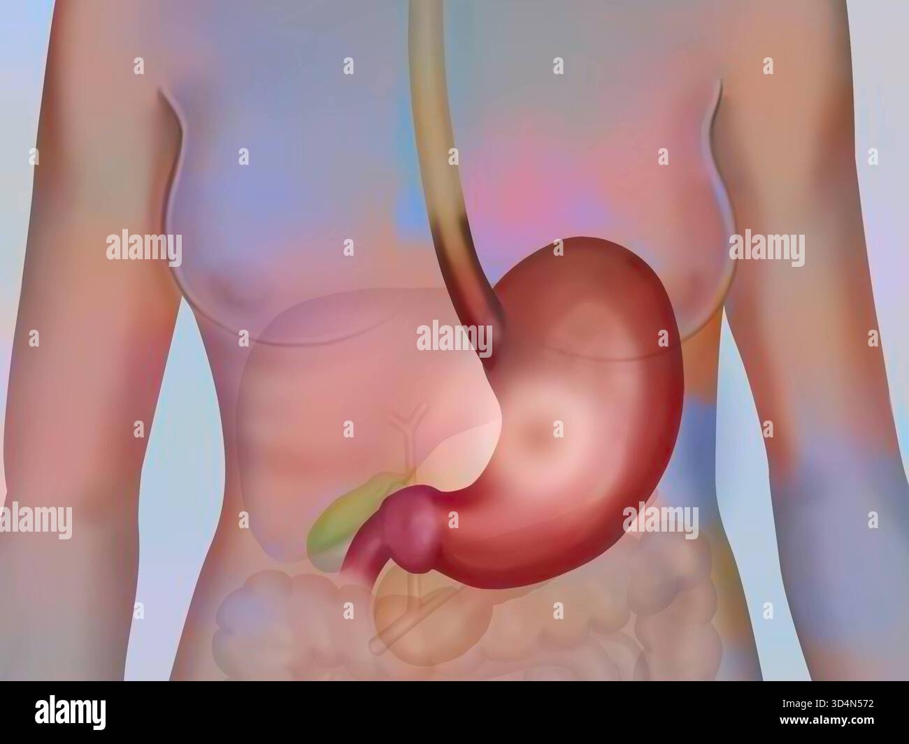 Stomach ulcer illustration hi-res stock photography and images - Alamy