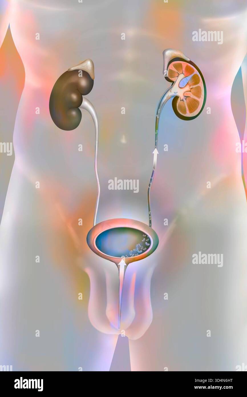Pyelocystitis. The infection of the bladder cystitis by bacteria has ...