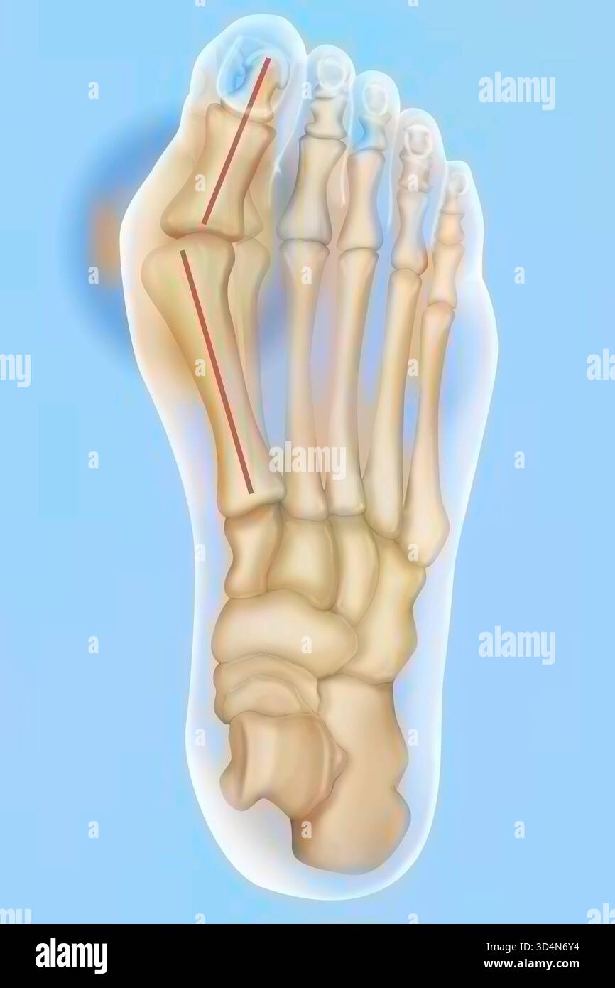 Hallux valgus bunion. Hallux valgus is an outward deviation of the big ...