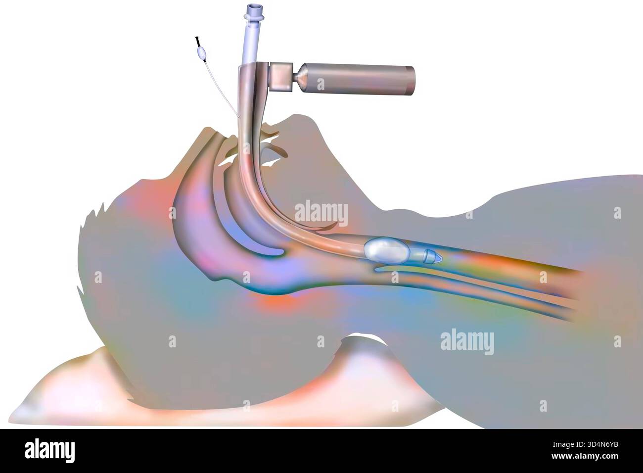 Intubation with laryngoscope hi-res stock photography and images - Alamy