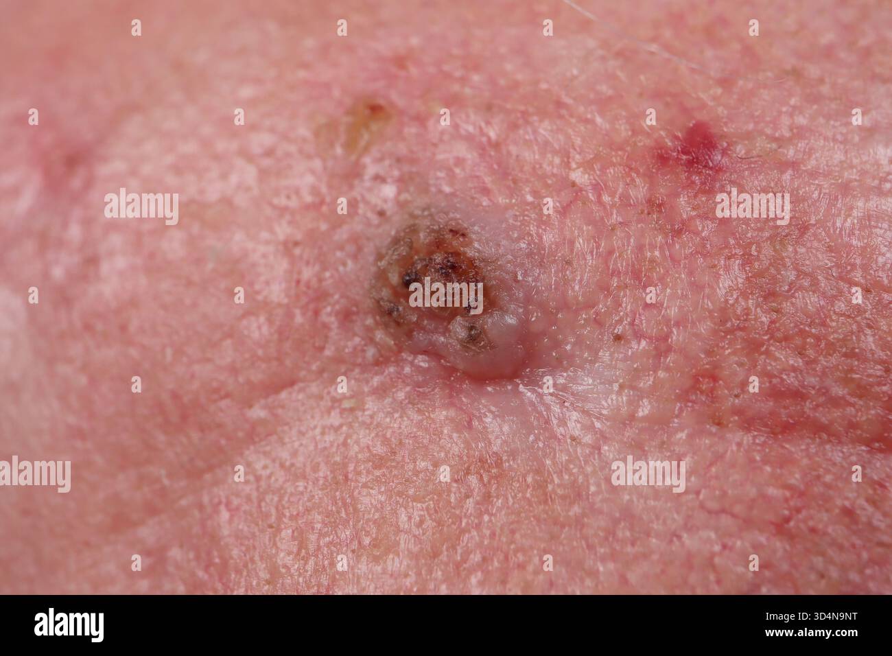Pre-epitheliomatous keratosis of the forehead in a 76-year-old man ...