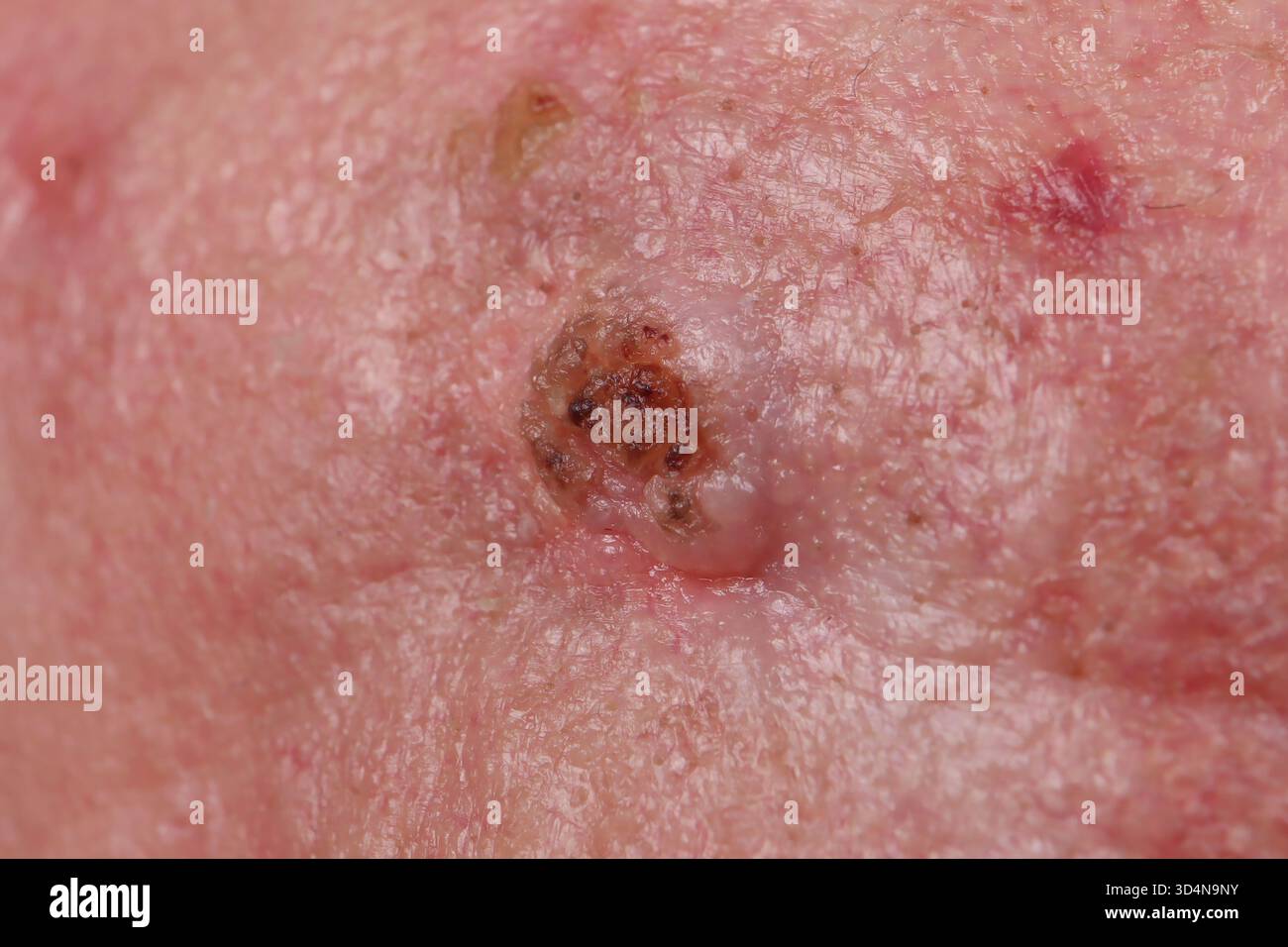 Pre-epitheliomatous keratosis of the forehead in a 76-year-old man ...