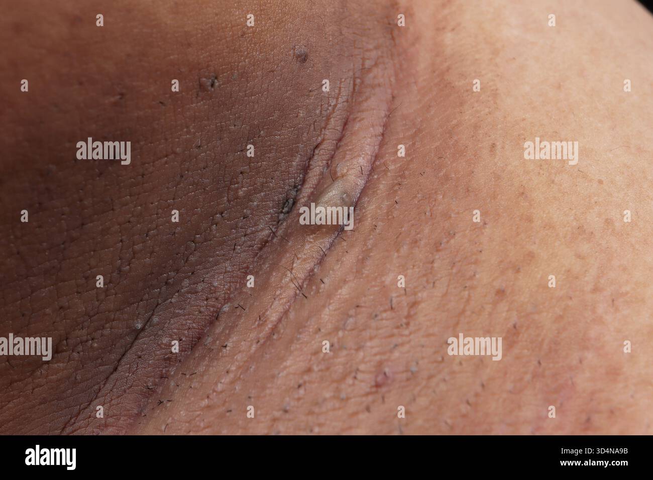 Epidermal cyst of the armpit in a 23-year-old woman Stock Photo - Alamy