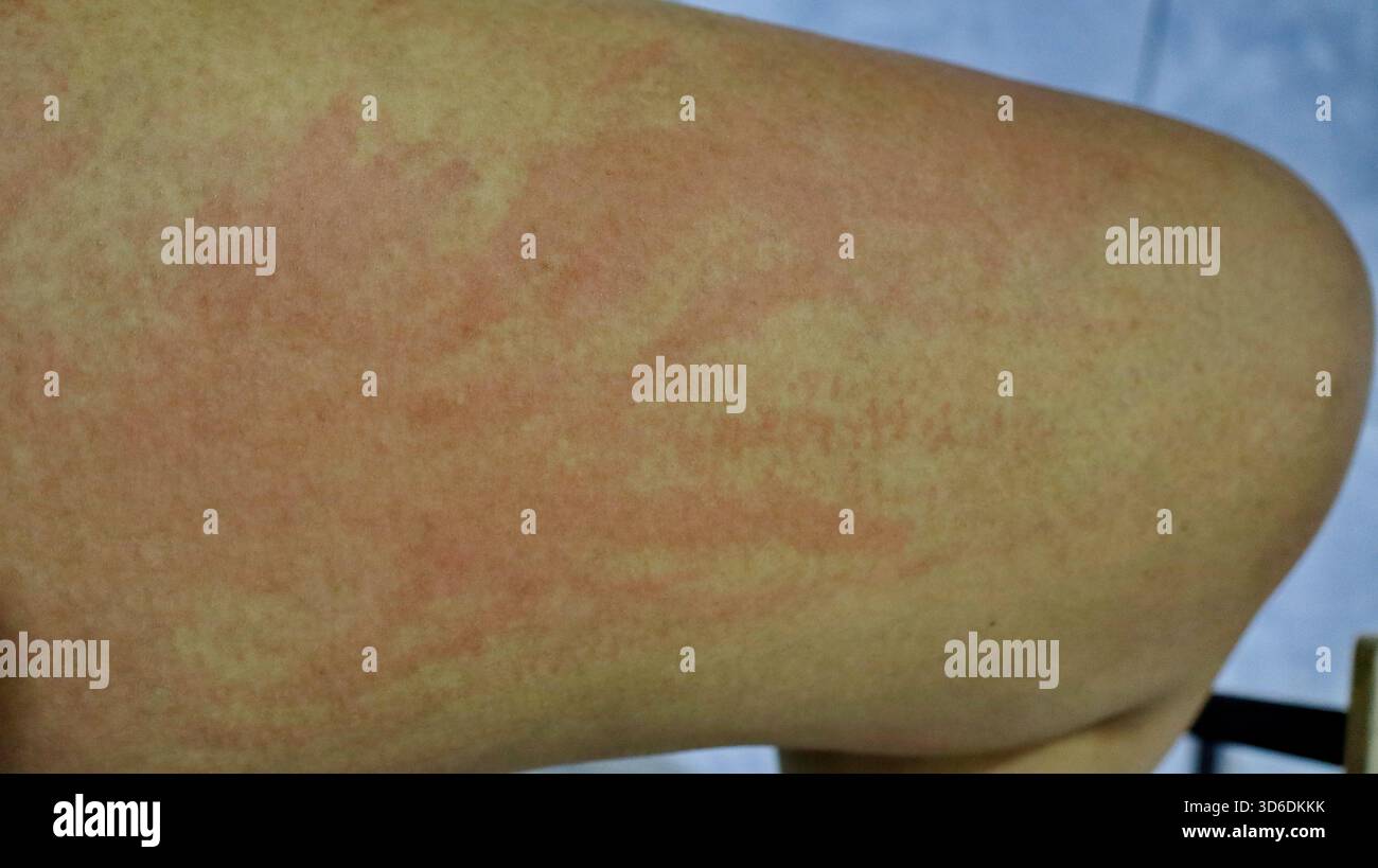Red Rash In Skin Humans Close up detail of human skin with red rash irritation, possible ...