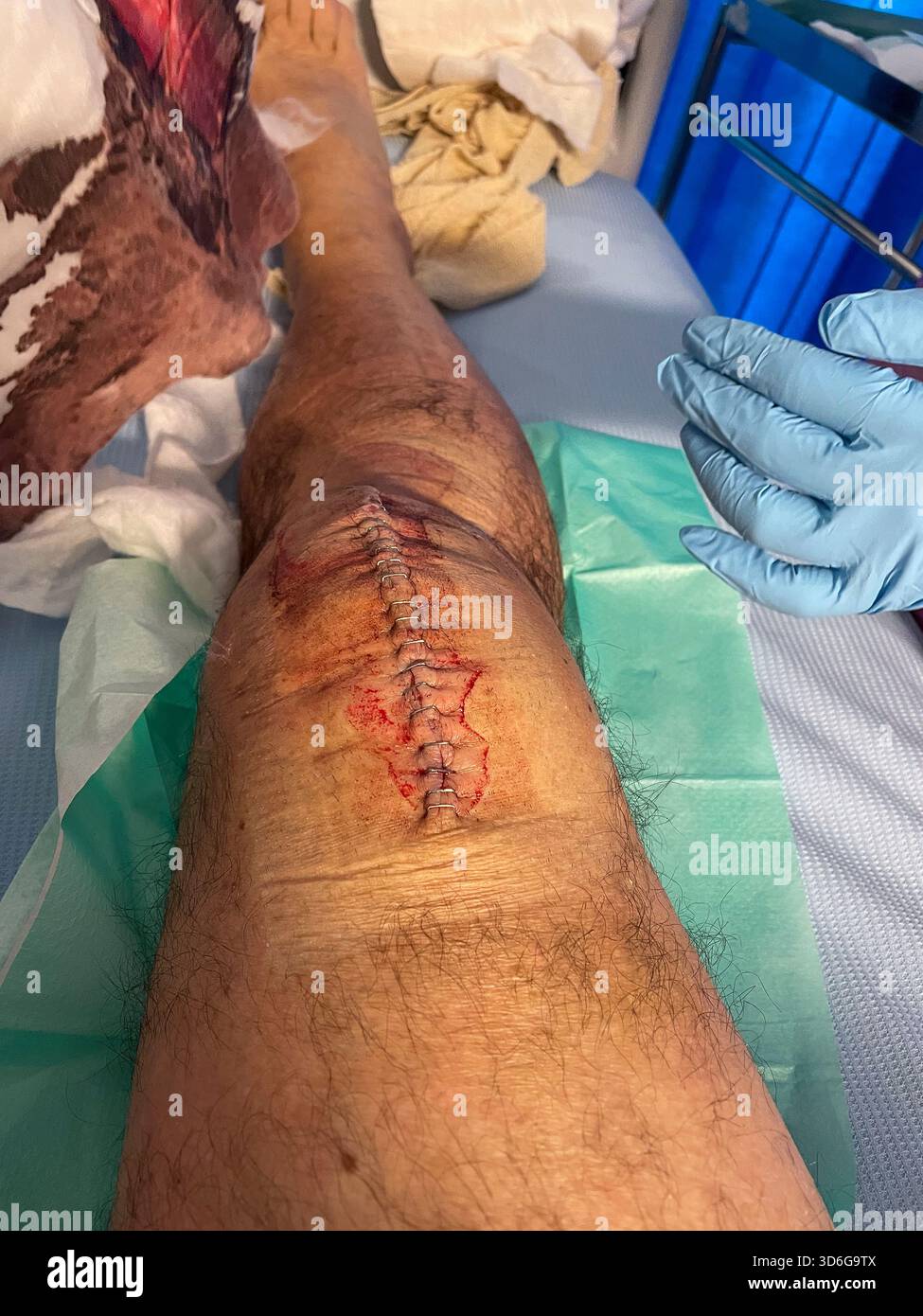 Clinical post-operative knee replacement with neatly aligned surgical staples on a healing midline incision: Phillip Roberts - Smartphone Captured Stock Image
