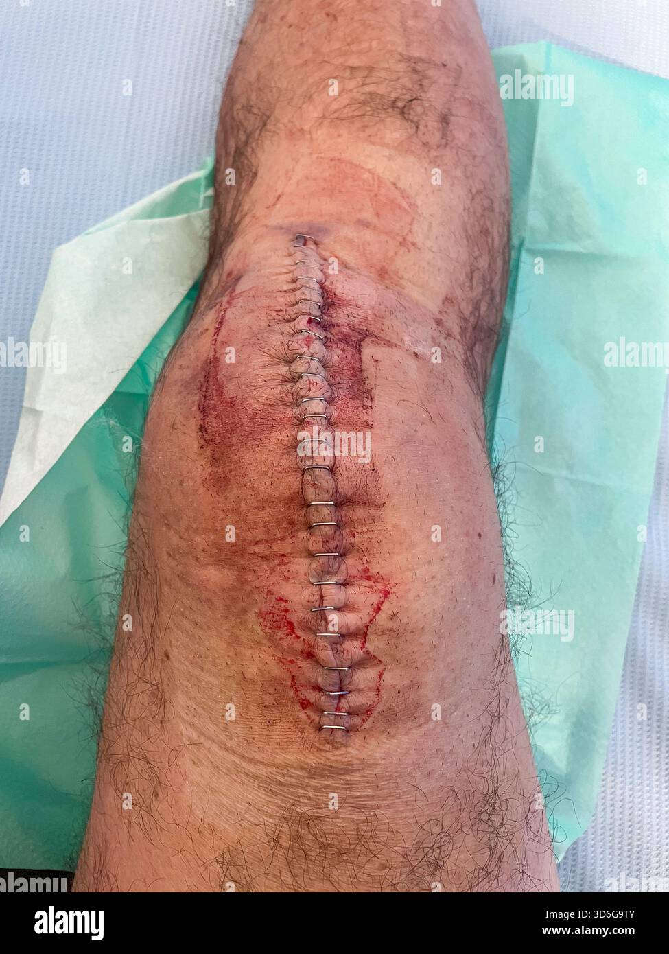 Clinical post-operative knee replacement with neatly aligned surgical staples on a healing midline incision: Phillip Roberts - Smartphone Captured Stock Image