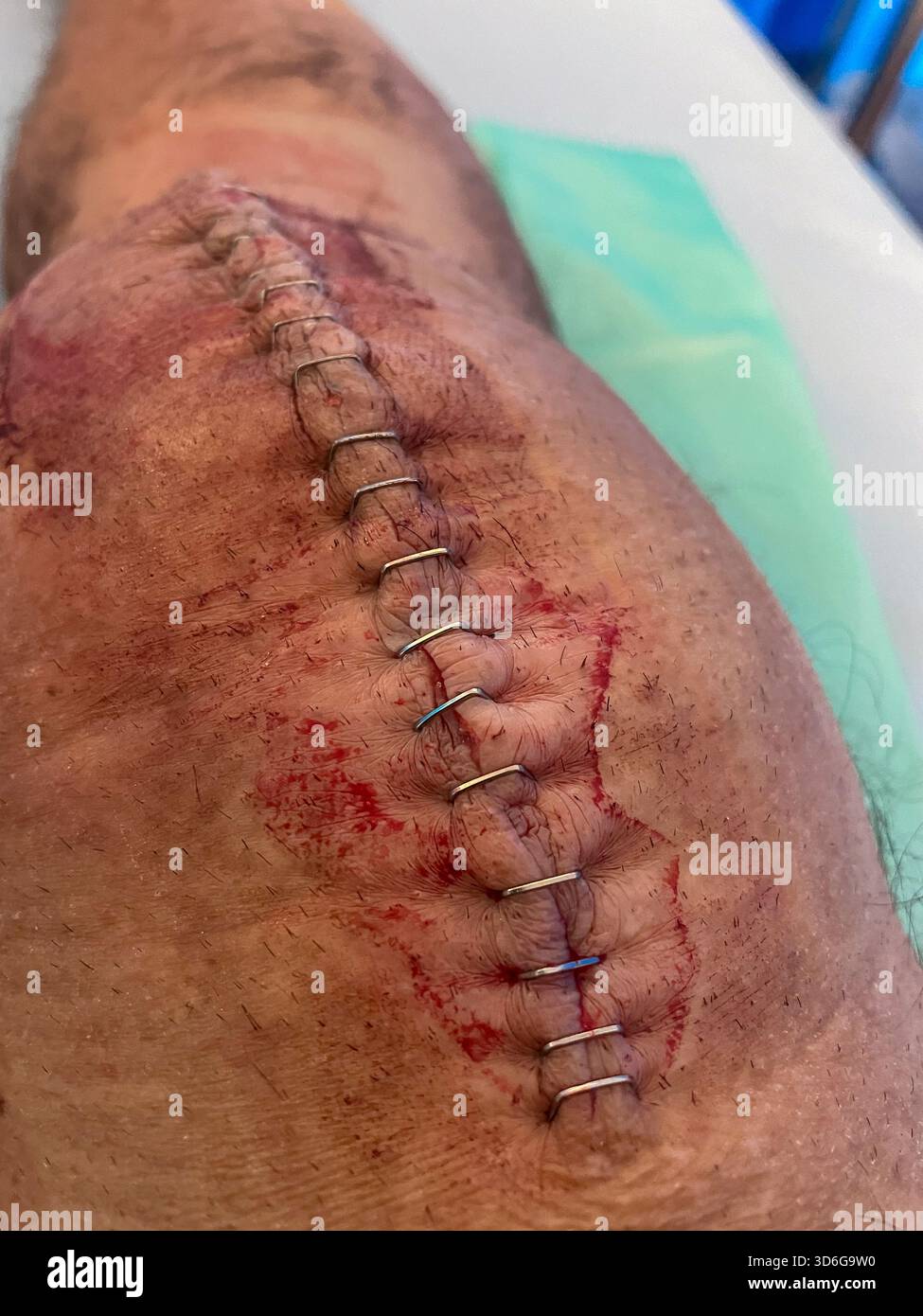 Clinical post-operative knee replacement with neatly aligned surgical staples on a healing midline incision: Phillip Roberts - Smartphone Captured Stock Image