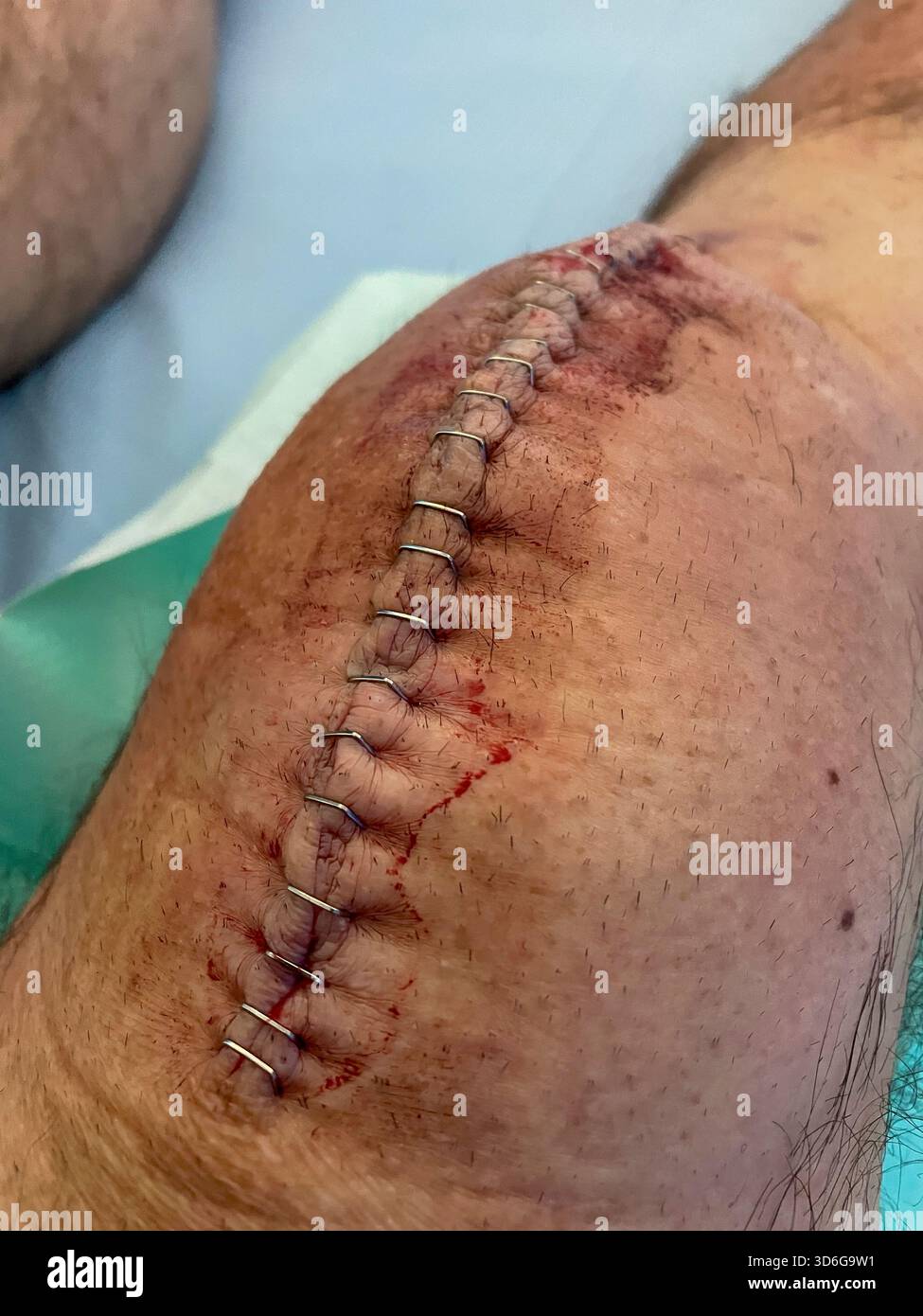 Clinical post-operative knee replacement with neatly aligned surgical staples on a healing midline incision: Phillip Roberts - Smartphone Captured Stock Image