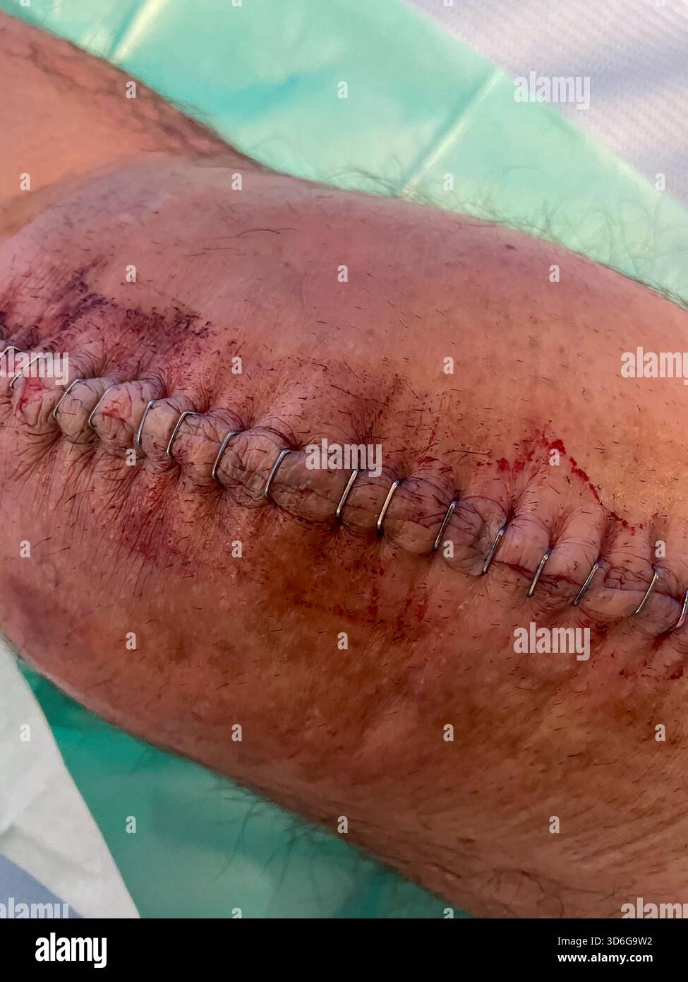 Clinical post-operative knee replacement with neatly aligned surgical staples on a healing midline incision: Phillip Roberts - Smartphone Captured Stock Image