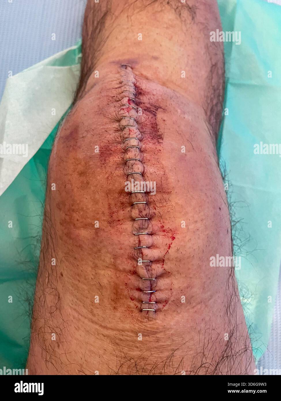 Clinical post-operative knee replacement with neatly aligned surgical staples on a healing midline incision: Phillip Roberts - Smartphone Captured Stock Image